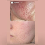 MELAPRO PLUS COLD PEEL, 10 ampulas pa 3 ml
