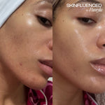 MELAPRO PLUS COLD PEEL, 10 ampulas pa 3 ml