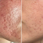 MELAPRO PLUS COLD PEEL, 10 ampulas pa 3 ml