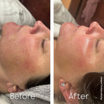 MELAPRO PLUS COLD PEEL, 10 ampulas pa 3 ml